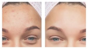 Acne Scars