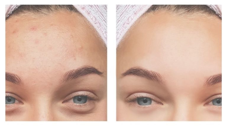 Acne Scars
